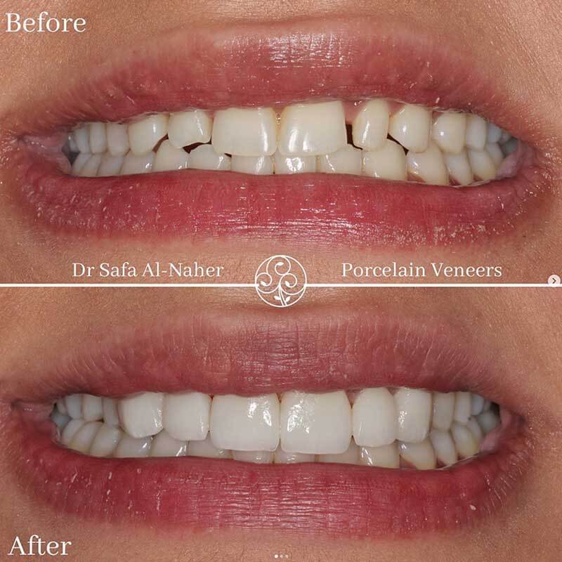 veneers-ba1