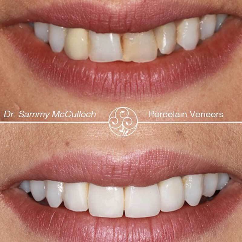 veneers-ba2