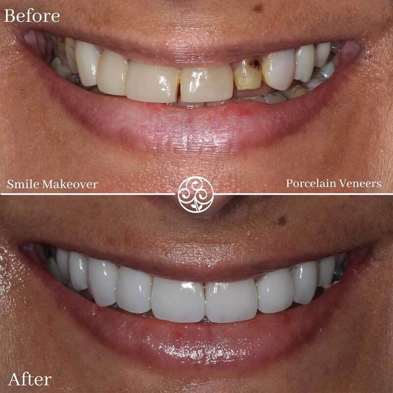 veneers-ba3