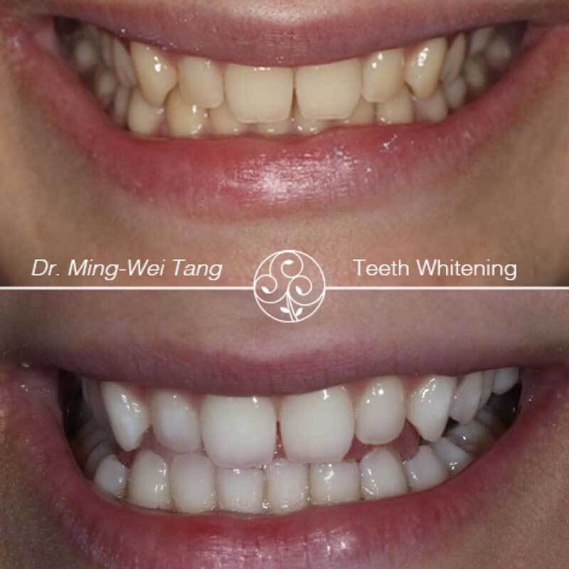 whitening-ba2